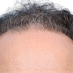 Fue Before and After | Dr. Jeffrey Wise