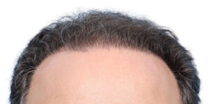 Fue Before and After | Dr. Jeffrey Wise