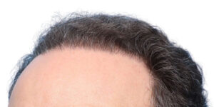Fue Before and After | Dr. Jeffrey Wise