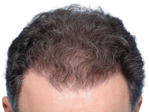 Fue Before and After | Dr. Jeffrey Wise