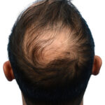 Fue Before and After | Dr. Jeffrey Wise