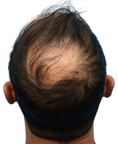 Fue Before and After | Dr. Jeffrey Wise