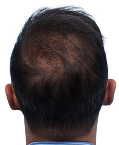 Fue Before and After | Dr. Jeffrey Wise
