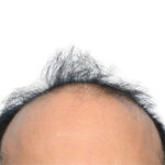Fue Before and After | Dr. Jeffrey Wise