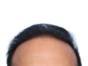 Fue Before and After | Dr. Jeffrey Wise