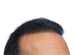 Fue Before and After | Dr. Jeffrey Wise