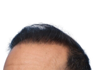 Fue Before and After | Dr. Jeffrey Wise