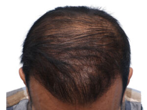 Fue Before and After | Dr. Jeffrey Wise