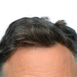 Fue Before and After | Dr. Jeffrey Wise