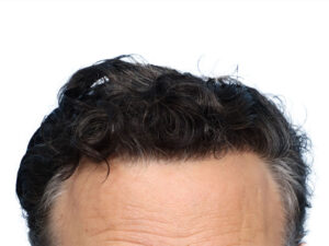 Fue Before and After | Dr. Jeffrey Wise