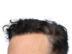 Fue Before and After | Dr. Jeffrey Wise