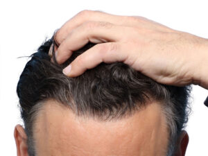 Fue Before and After | Dr. Jeffrey Wise