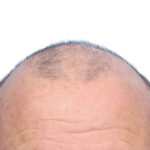 Fue Before and After | Dr. Jeffrey Wise