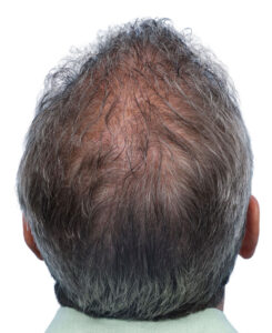 Fue Before and After | Dr. Jeffrey Wise