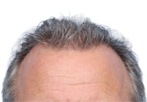 Fue Before and After | Dr. Jeffrey Wise