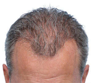 Fue Before and After | Dr. Jeffrey Wise