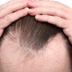 Fue Before and After | Dr. Jeffrey Wise