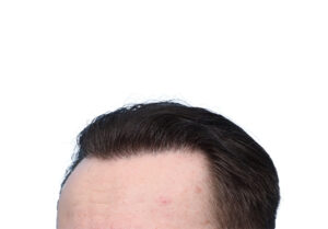 Fue Before and After | Dr. Jeffrey Wise