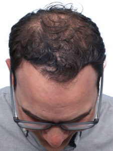 Fue Before and After | Dr. Jeffrey Wise