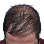 Fue Before and After | Dr. Jeffrey Wise