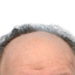 Fue Before and After | Dr. Jeffrey Wise