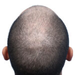 Fue Before and After | Dr. Jeffrey Wise