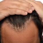 Fue Before and After | Dr. Jeffrey Wise