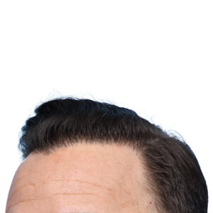 Fue Before and After | Dr. Jeffrey Wise