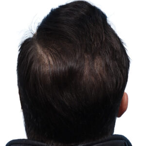Fue Before and After | Dr. Jeffrey Wise