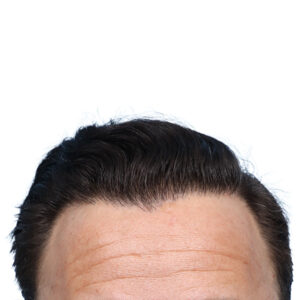 Fue Before and After | Dr. Jeffrey Wise