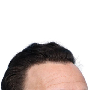 Fue Before and After | Dr. Jeffrey Wise