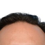 Fue Before and After | Dr. Jeffrey Wise
