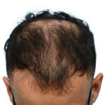 Fue Before and After | Dr. Jeffrey Wise