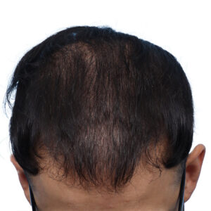 Fue Before and After | Dr. Jeffrey Wise