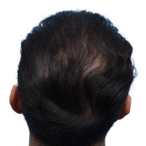 Fue Before and After | Dr. Jeffrey Wise