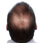 Fue Before and After | Dr. Jeffrey Wise