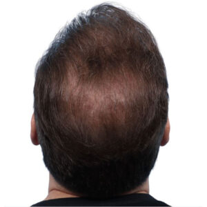 Fue Before and After | Dr. Jeffrey Wise