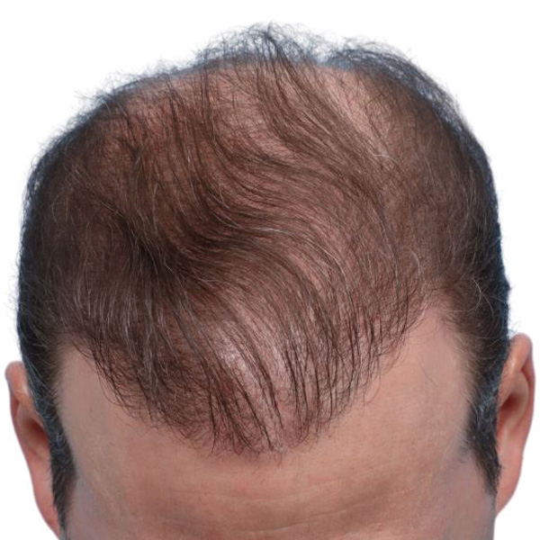 Fue Before and After | Dr. Jeffrey Wise