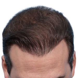 Fue Before and After | Dr. Jeffrey Wise