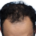 Fue Before and After | Dr. Jeffrey Wise