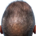 Fue Before and After | Dr. Jeffrey Wise