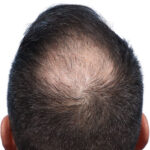 Fue Before and After | Dr. Jeffrey Wise