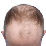 Fue Before and After | Dr. Jeffrey Wise