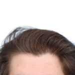 Fue Before and After | Dr. Jeffrey Wise