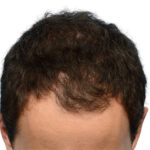 Fue Before and After | Dr. Jeffrey Wise