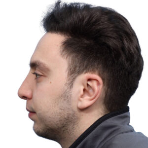 Fue Before and After | Dr. Jeffrey Wise