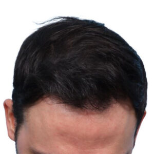 Fue Before and After | Dr. Jeffrey Wise