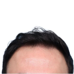 Fue Before and After | Dr. Jeffrey Wise