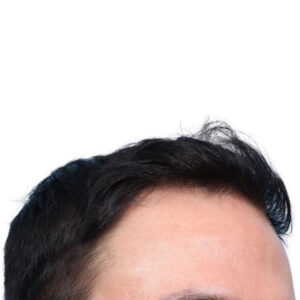 Fue Before and After | Dr. Jeffrey Wise