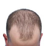 Fue Before and After | Dr. Jeffrey Wise